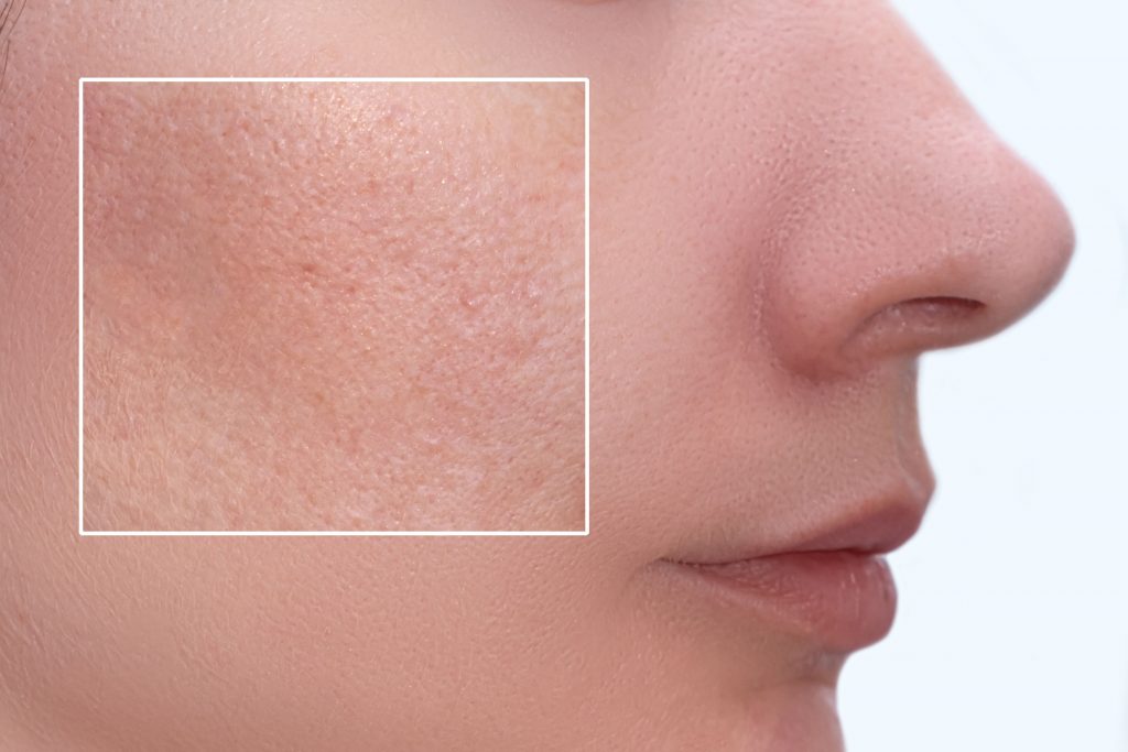 4 Methods To Minimise The Appearance Of Large Pores